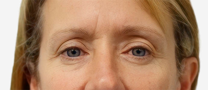Eyelid Surgery