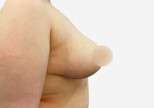 Breast Lift