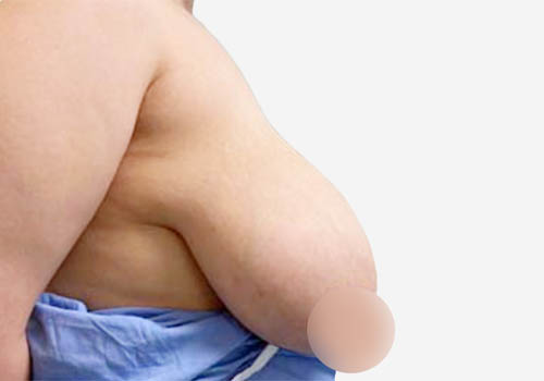 Breast Lift