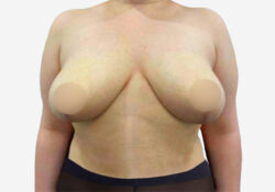 Breast Lift