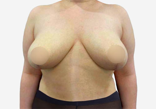Breast Lift Case 6546 After Photo Breast Lift