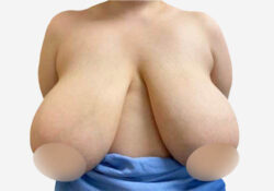 Breast Lift