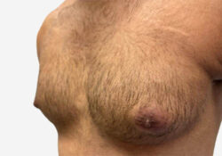 Male Breast Reduction