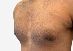 Male Breast Reduction