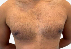 Male Breast Reduction