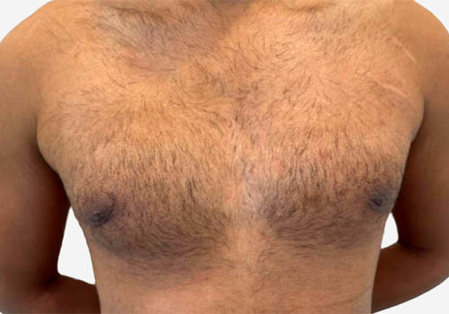 male breast reduction before and after photos by Toronto plastic surgeon Dr. Golger