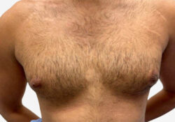 Male Breast Reduction