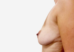 Breast Lift