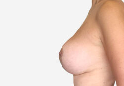 Breast Lift