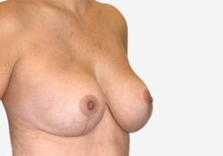 Breast Lift