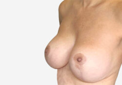 Breast Lift