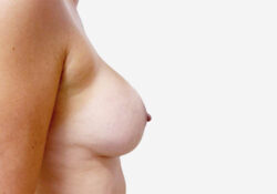 Breast Lift