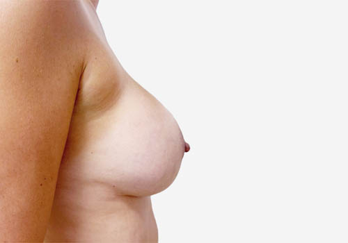 Breast Lift