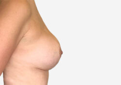 Breast Lift