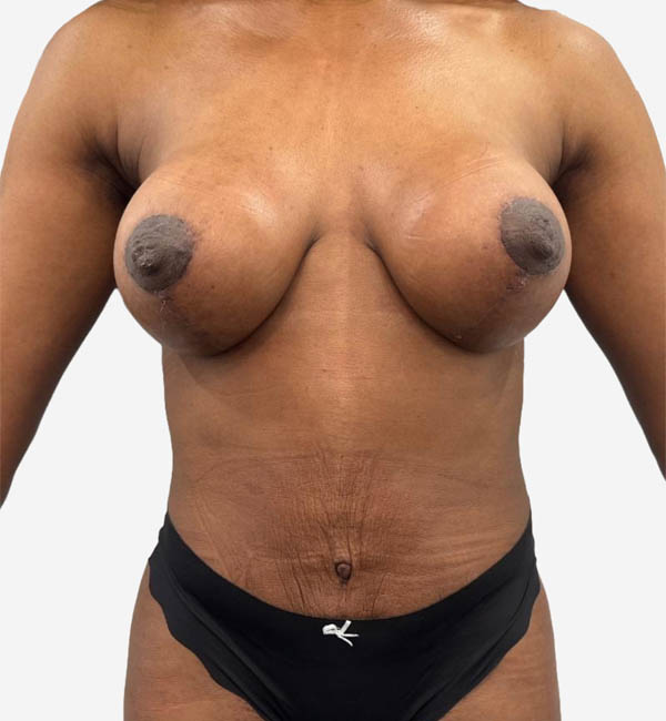 Mommy Makeover Case 41200 After Photo Mommy Makeover