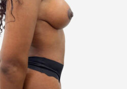 Tummy Tuck