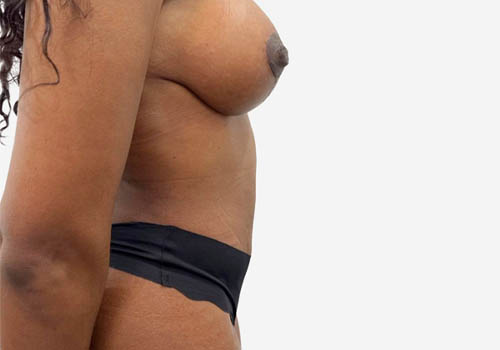 Tummy Tuck