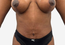 Tummy Tuck