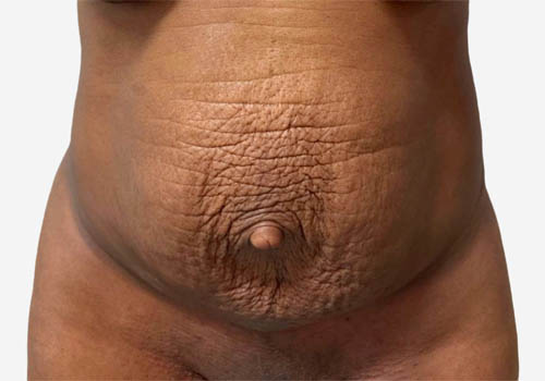 Tummy Tuck Case 41200 Before Photo Tummy Tuck