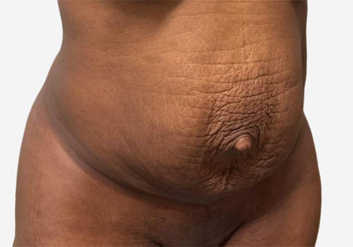 Tummy Tuck