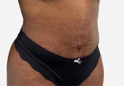 Tummy Tuck