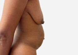 Tummy Tuck