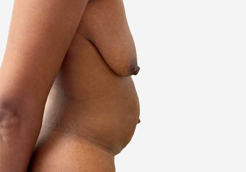 Tummy Tuck