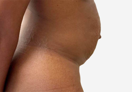 Tummy Tuck