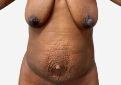 Tummy Tuck