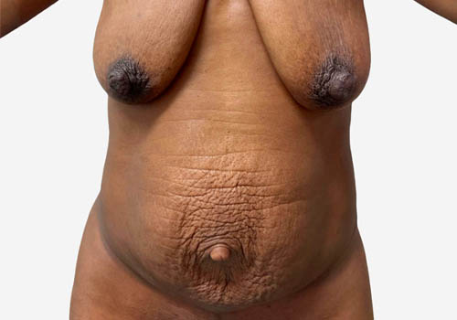 Tummy Tuck Case 41200 Before Photo Tummy Tuck