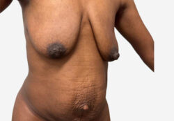 Tummy Tuck