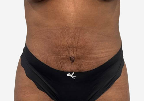 Tummy Tuck Case 41200 After Photo Tummy Tuck