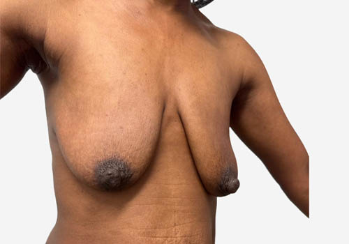 Breast Lift