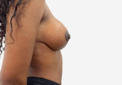 Breast Lift
