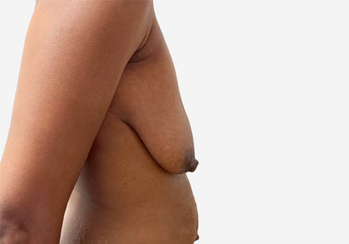 Breast Lift