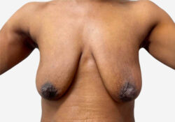 Breast Lift