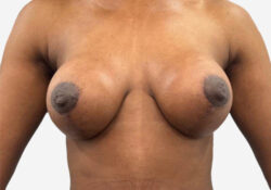 Breast Lift