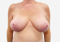 Breast Lift