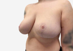 Breast Reduction