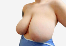 Breast Reduction
