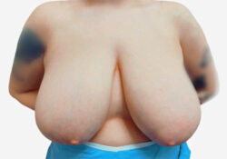 Breast Reduction