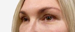 Eyelid Surgery