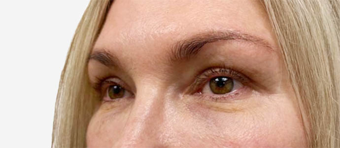 Eyelid Surgery