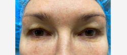 Eyelid Surgery