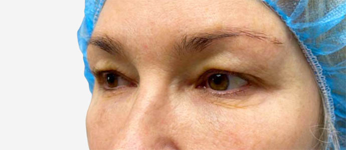 Eyelid Surgery
