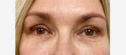 Eyelid Surgery