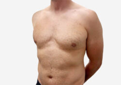 Male Breast Reduction