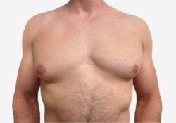 Male Breast Reduction