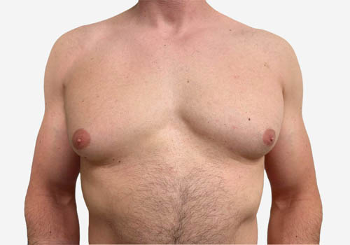 Male Breast Reduction Case 62457 Before Photo Male Breast Reduction