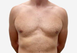 Male Breast Reduction